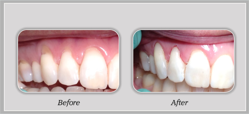 Before and After Dental Treatment