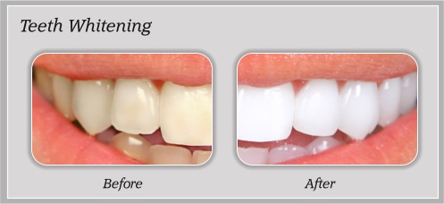 Before and After Dental Treatment
